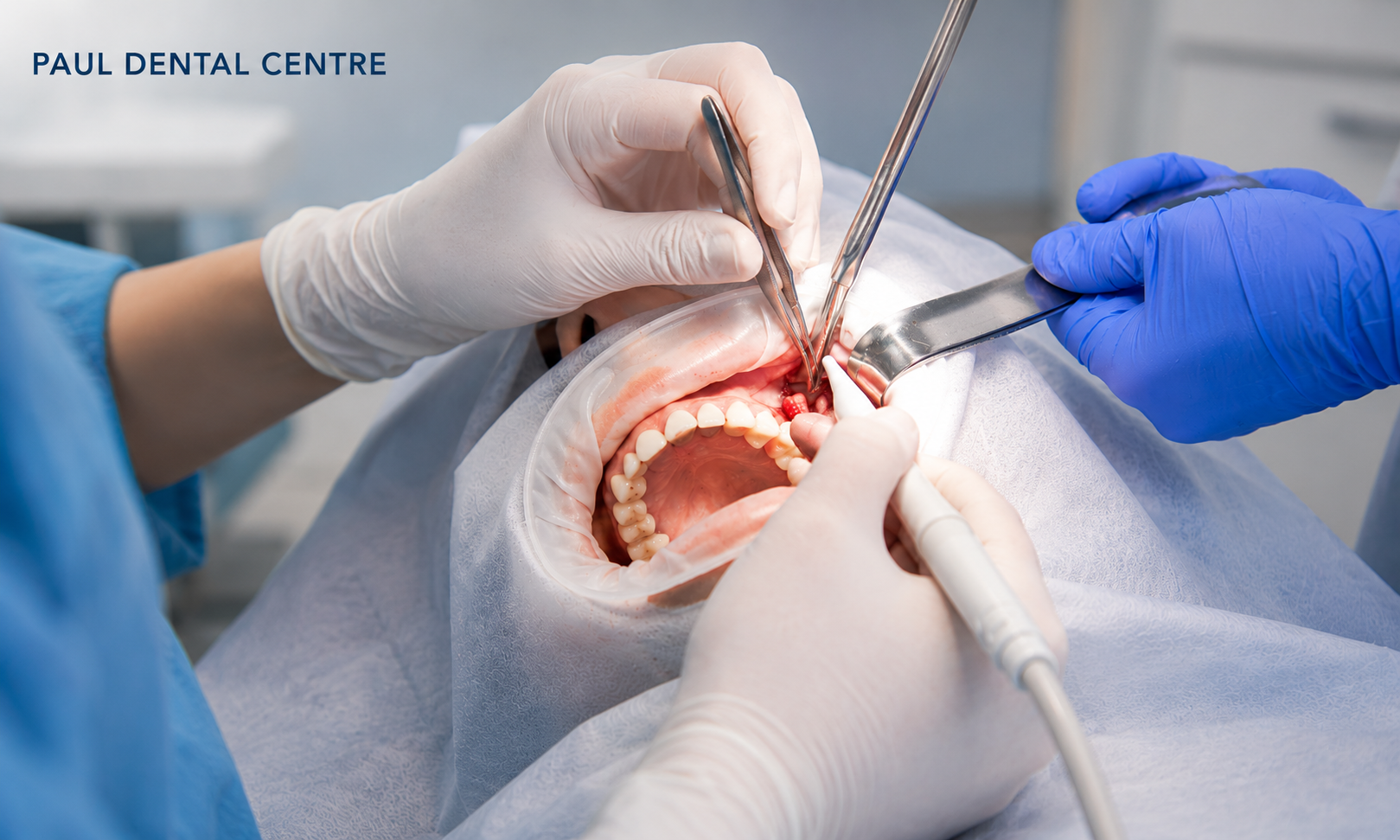Oral Surgery & Extractions at Paul Dental Center